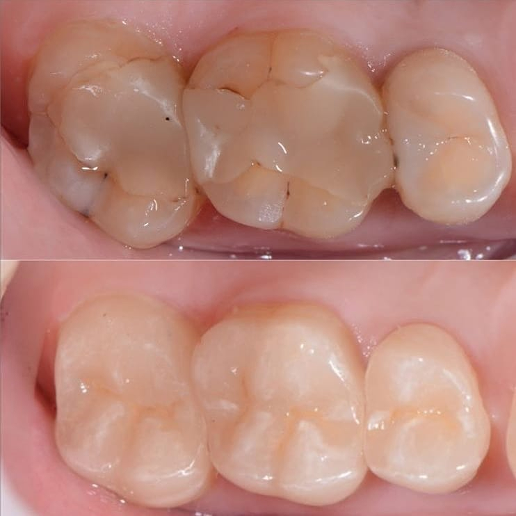 На фото сверху: запломбированные зубы, снизу — перелеченные с использованием керамических вкладок